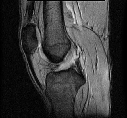 Anterior Cruciate Ligament Mri