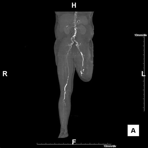 Management of Popliteal Artery Aneurysm - American College of Cardiology