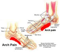 Pain in the arch of the foot