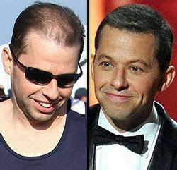 The Jon Cryer hair system mystery - His Hair Clinic