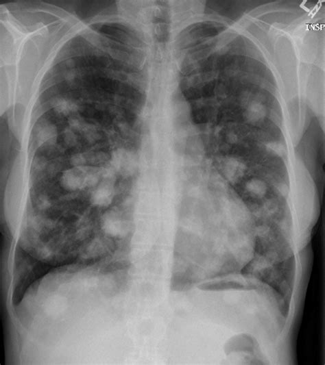 What Causes Pulmonary Nodules