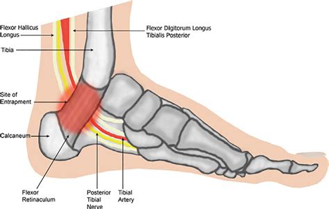 Tarsal Tunnel Syndrome: Symtoms, Causes and Treatments - SportsMD