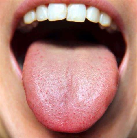 You Can’t Ignore These Things Your Tongue is Warning You About