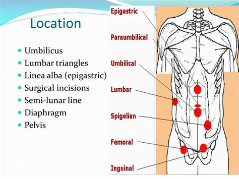 PPT - hernia PowerPoint Presentation - ID:2957512