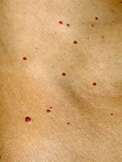 Angioma on the Skin. Red Moles on the Body. Many Birthmarks. Stock Photo - Image of brown ...