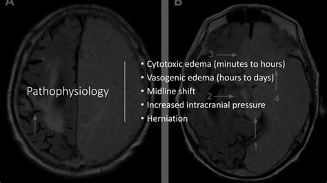 Decompressive hemicraniectomy for Large Hemispheric infarction | PPT