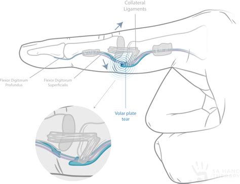 Volar Plate Joint Injury - SA Hand Therapy