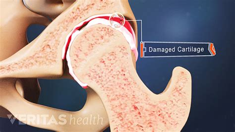 5 Risk Factors for Hip Arthritis