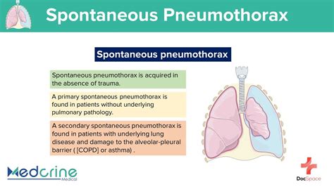 Spontaneous Pneumothorax: Causes, Clinical features, Pathophysiology and Diagnosis - YouTube