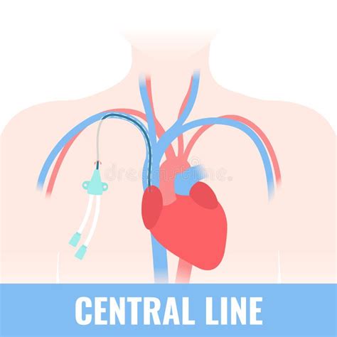 Tunneled Central Line Venous Catheter Medical Diagram Stock Vector ...