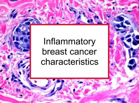 Inflammatory breast cancer: Best Health Guide 2023 - eHealth Magazine