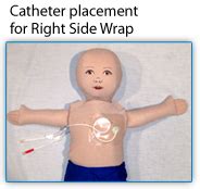 Catheter placement for Right Side Wrap | Pediatrics, Catheter, Central line
