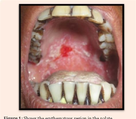 Figure 1 from Diagnosis and Management of Pseudomembranous Candidiasis | Semantic Scholar