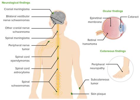 Neurofibromatosis Type 2 | Concise Medical Knowledge