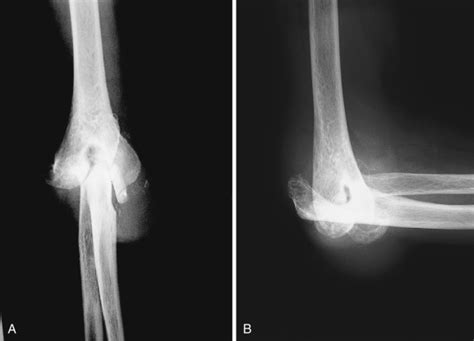 Total Elbow Arthroplasty | Musculoskeletal Key