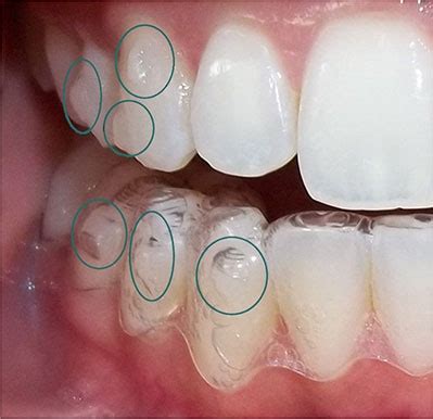 Patient Story: The Invisalign Installation Process | SF Dental