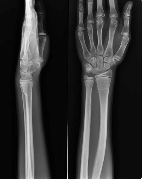 Torus fracture definition, causes, diagnosis & torus fracture treatment