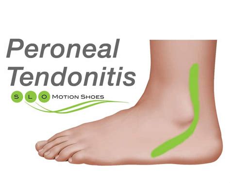 Peroneal-Tendonitis - SLO Motion ShoesSLO Motion Shoes