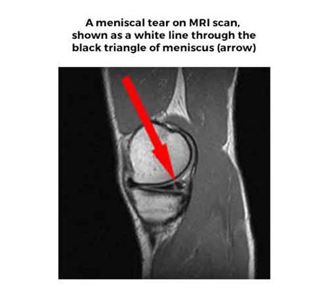 Meniscal Cartilage Tears & Injuries: Symptoms, Diagnosis & Treatments