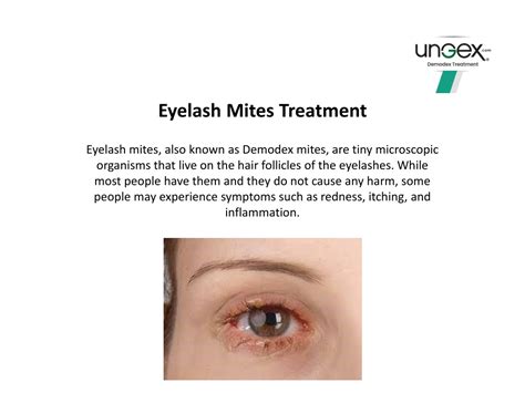 PPT - Eyelash Mites Treatment PowerPoint Presentation, free download ...