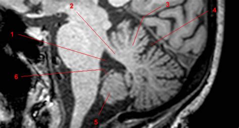 Cerebellum - W-Radiology