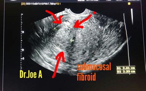 Ultrasound imaging: Submucosal fibroid