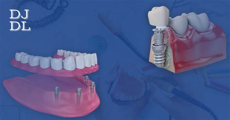 Types of Overdenture Implants | Dave Johnson Dental Lab