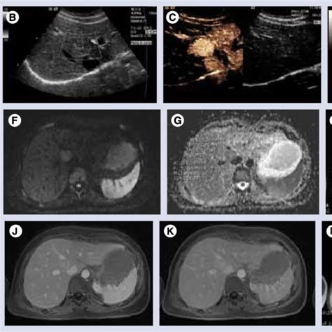 Focal nodular hyperplasia. Ultrasound examination reveals a... | Download Scientific Diagram