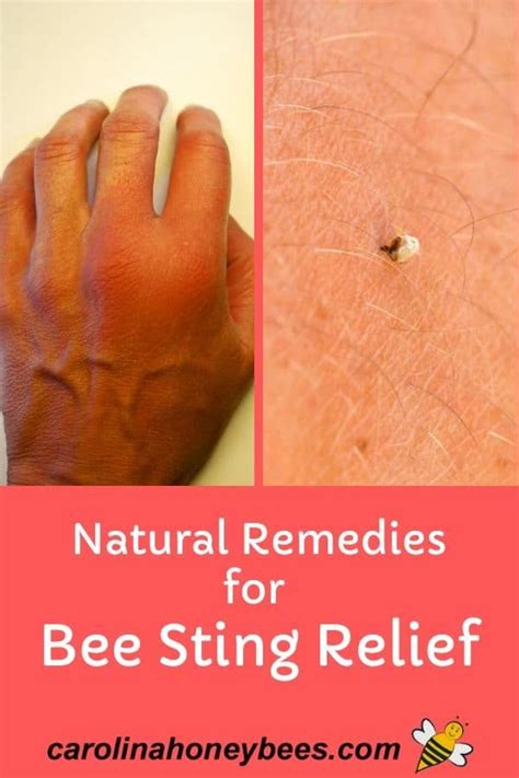 Easy Home Remedies for Bee Stings - Carolina Honeybees in 2020 ...