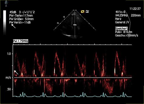 Pulsed-wave Doppler across mitral valve demonstrating near normal ...