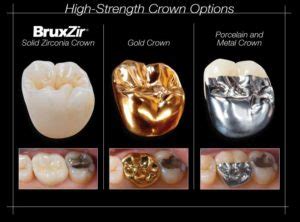 What Kind of Dental Crown Material is Best?