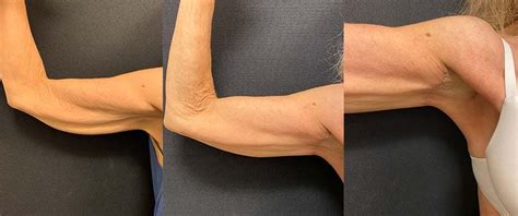 Before & After: Mini Arm Lift | Neinstein Plastic Surgery