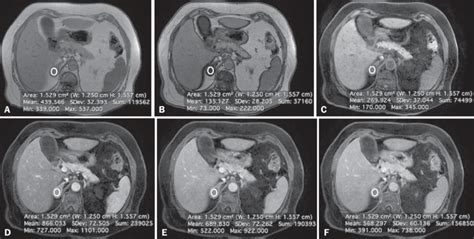 Lipid-rich adenoma in a 66-year-old woman. Transverse, T1-weighted... | Download Scientific Diagram