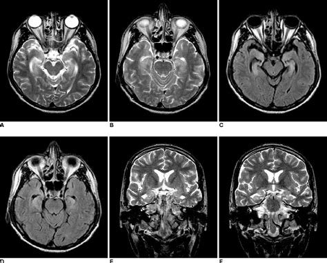 Figure 1 from MRI of Neurosyphilis Presenting as Mesiotemporal ...