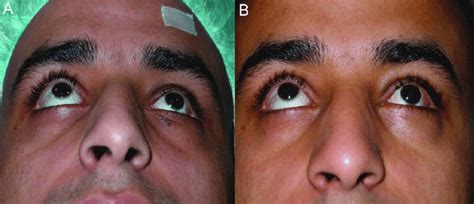 A) Preoperative picture of case 3. Patient has significant enophthalmos ...