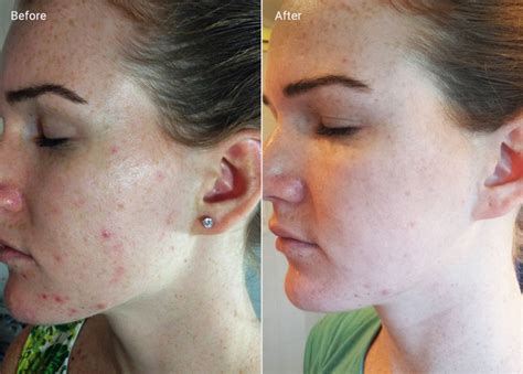 Microdermabrasion Results: Benefits, How to Maintain, Before & Afters