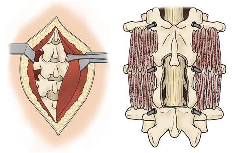 Minimally-Invasive Vs. Traditional Open Spine Surgery: Explained | The Spine Center