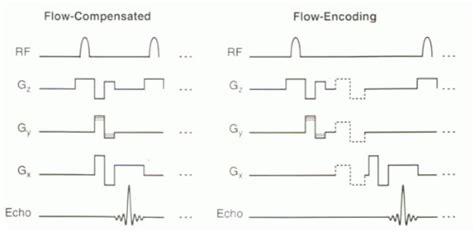 Phase Contrast MRI: Flow Quantification and MRA | Thoracic Key