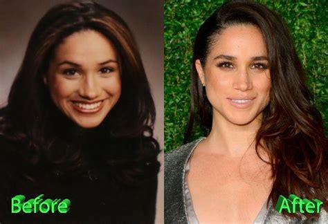 Meghan before and after rhinoplasty operation (nose) | Rhinoplasty ...