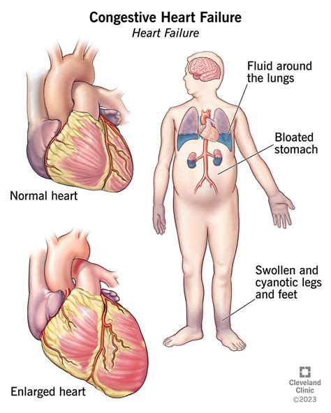 Coronary Artery Disease Symptoms