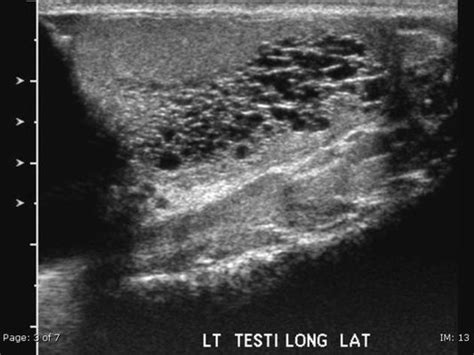 Mediastinum Testis Ultrasound