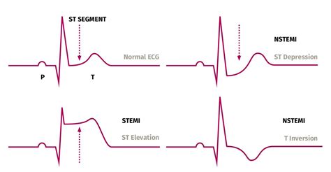 심근경색 MI myocardial infarction 증상 원인 검사 심전도 치료 시술 수술 AMI ACS STEMI NSTEMI (+협심증 angina 차이) : 네이버 블로그