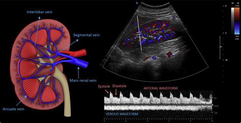 Color and pulsed-wave Doppler images of the renal interlobar vessels ...