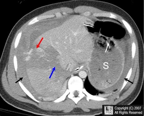 Learning Radiology - Liver, Laceration, Hepatic