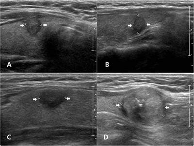 Frontiers | Ultrasonographic Features of Papillary Thyroid Carcinomas ...