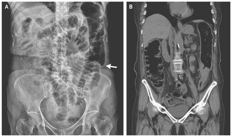 Colon Cutoff Sign due to Adenocarcinoma - Manual of Medicine