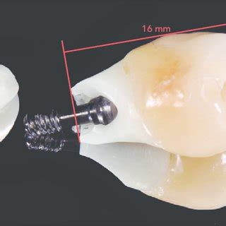 Fractured zirconia abutment with external connection regular platform... | Download Scientific ...