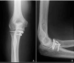 The coronoid process and its importance in the human body