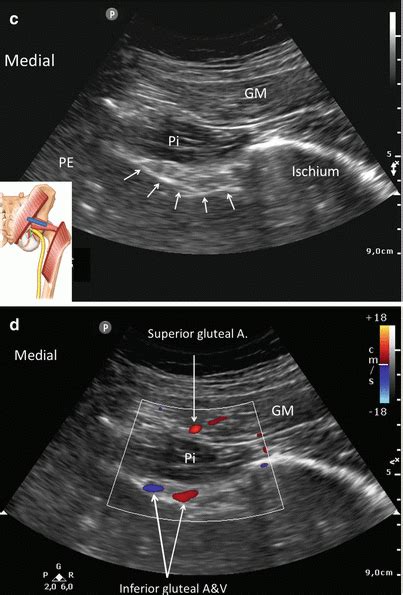 Injection for Piriformis Syndrome | Anesthesia Key