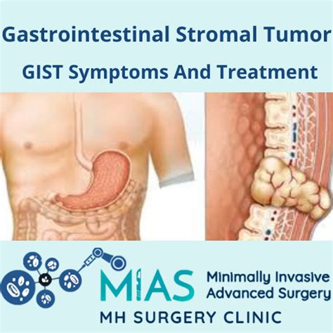 GIST Symptoms And Treatment | Gastrointestinal Stromal Tumor